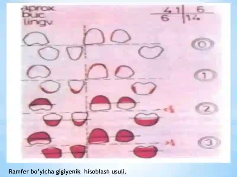 Og’iz bo’shlig’i gigiyenasi indeksi ko’rsatkichlari.JSST kriteriylari. 3
