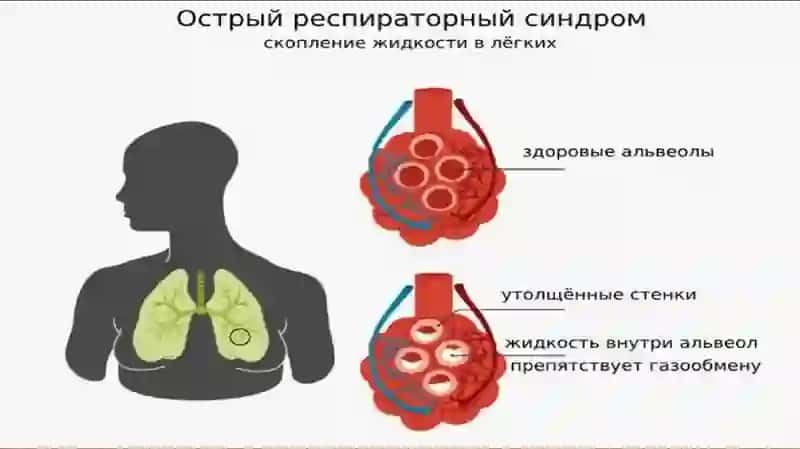 RDS sindrom. Etiologiyasi, patogenizi, diagnostikasi. Intensiv terapiya. 3
