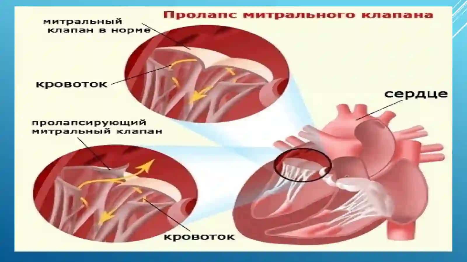 MITRAL KLAPAN PROLAPSI 3
