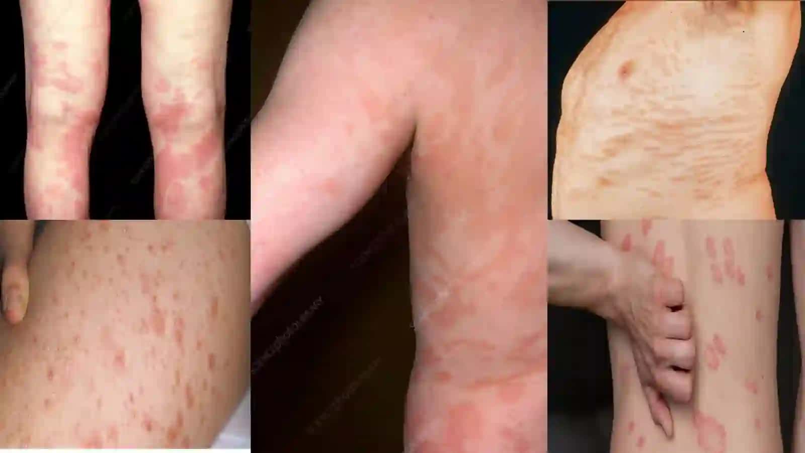Parapsoriaz. Psoriaz va boshqa dermatozlarda davolashda kvant (PUVA, lazeroterapiya) terapiyaning zamonaviy asoslari 3