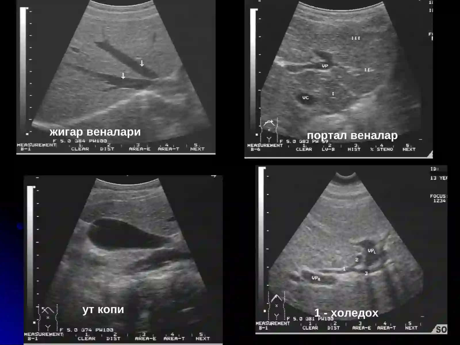Жигар касалликлари нур ташхиси 3