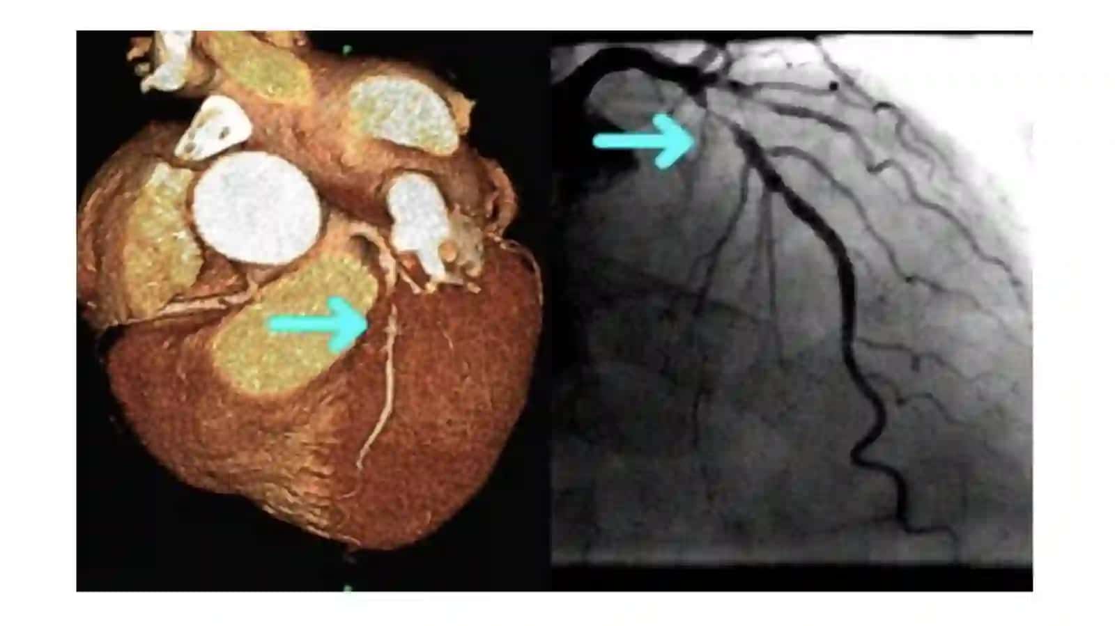 MSKT-angiografiyada aorta va  uning asosiy tarmoqlari  Anatomik variantlar va rivojlanish  nuqsonlari 3