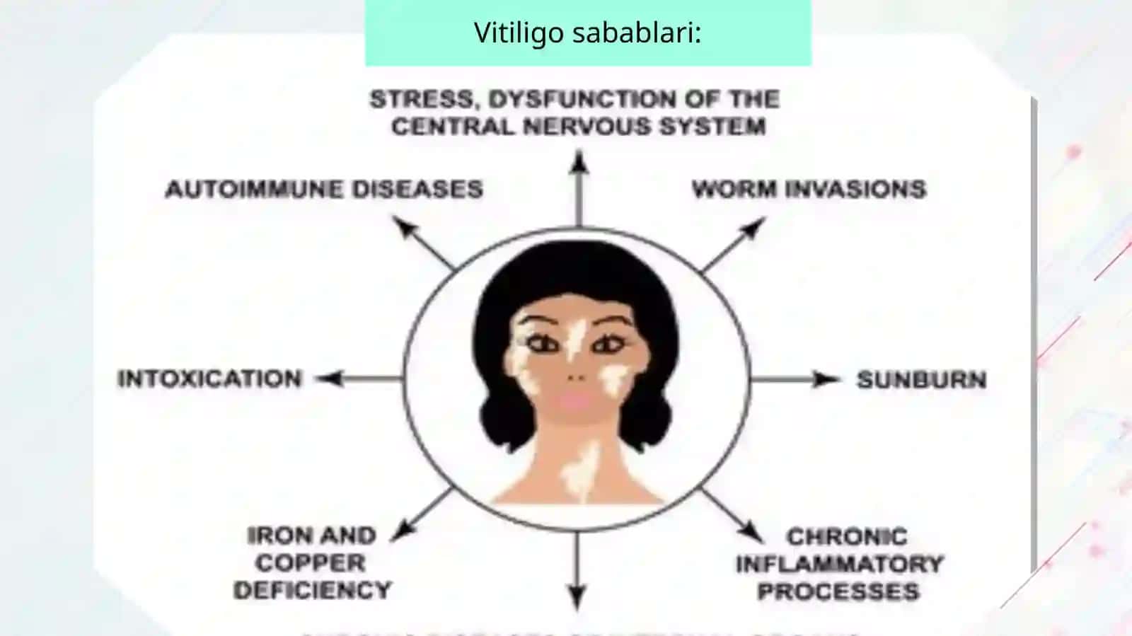 Vitiligo kasalligi 3