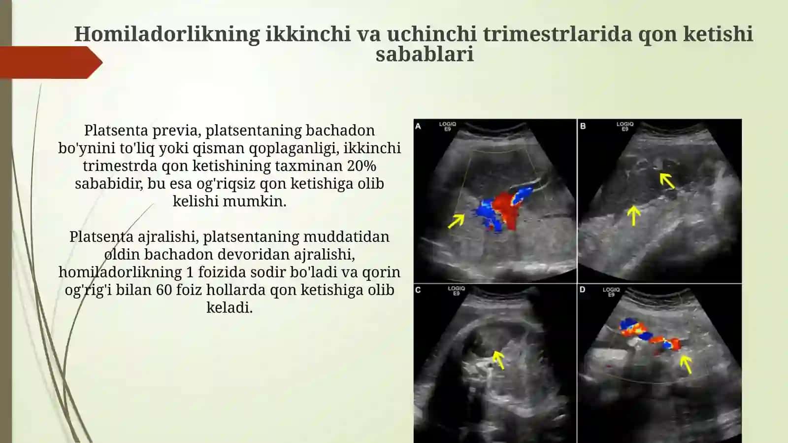 Homiladorlikning ikkinchi va uchinchi trimestrlarida qon ketishi va uning sabablari 3