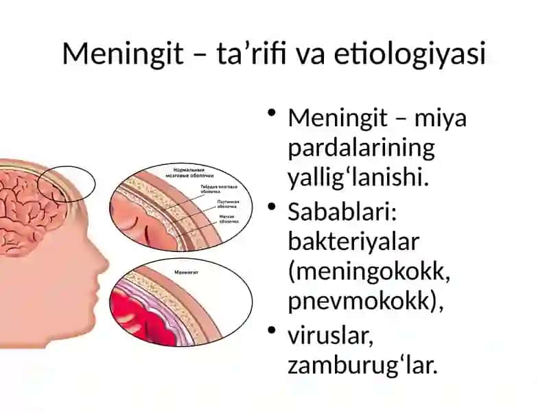 MNS ning yuqumli kasalliklari: meningit, ensefalit 3