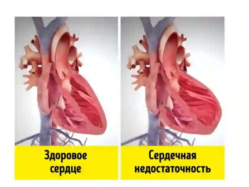 Yurak yetishmovchiligi 3