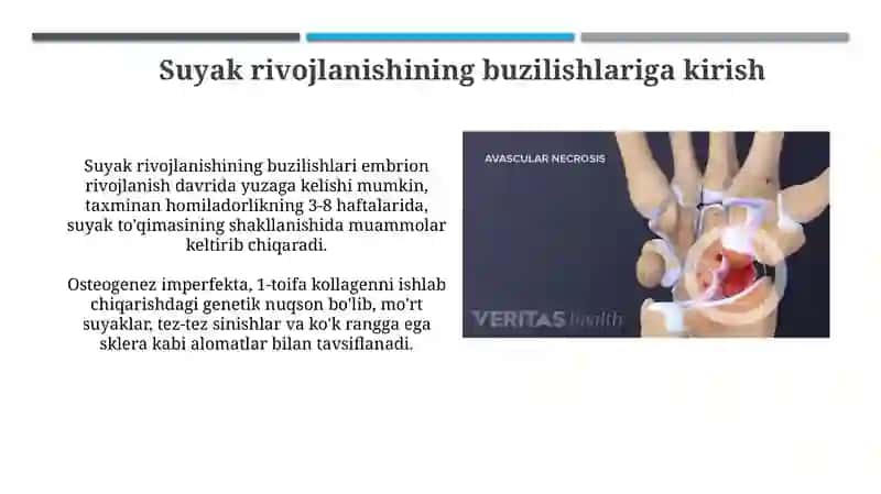 Suyaklarni rivojlanishini buzilishlari.Sinishlar.Ostionekroz 3