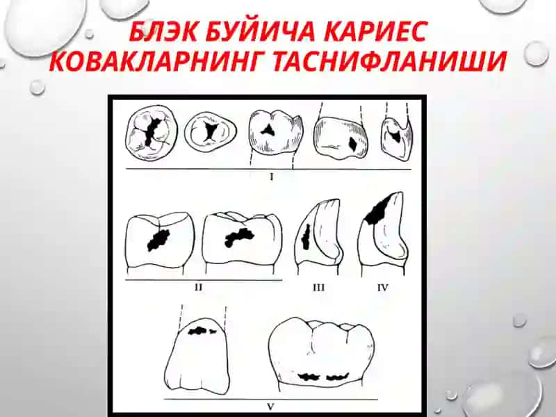 II синф кариоз бушликларини чархлаш ва пломбалаш 3