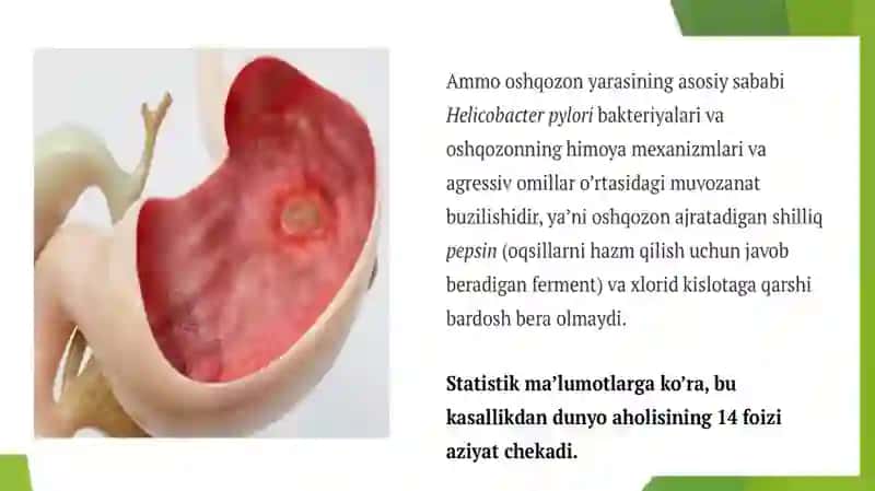 Oshqozon yara va 12 barmoq ichak kasalliklari 3