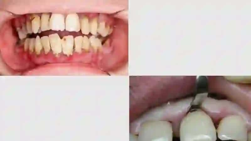 Milk osti tish toshlarining parodontitlar hosil bo'lishidagi ahamiyati 3