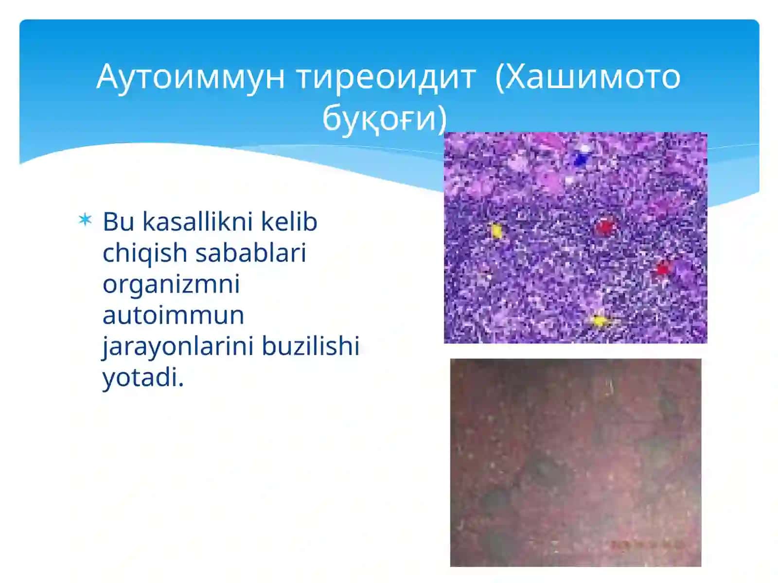 Тиреоидитлар 3