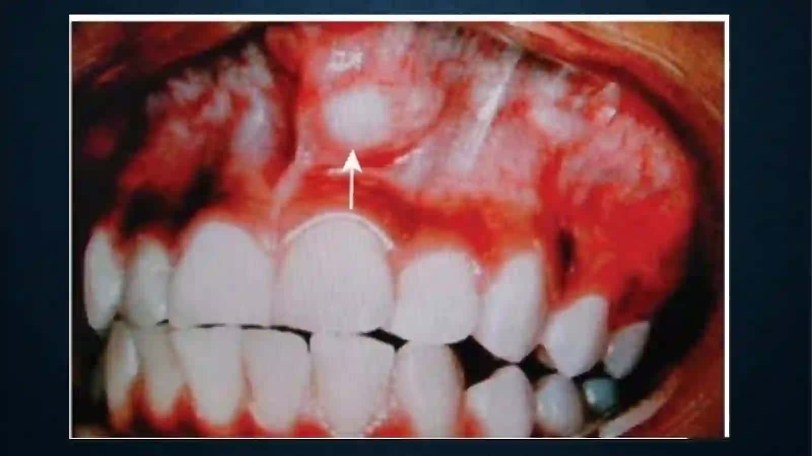 SO’LAK BEZLARI O’SMALARI. MONOMORF ADENOMA, POLIMORF ADENOMA, MUKOEPIDERMOID O’SMA. KLINIKASI TASHXISLASH VA DAVOLASH. 4