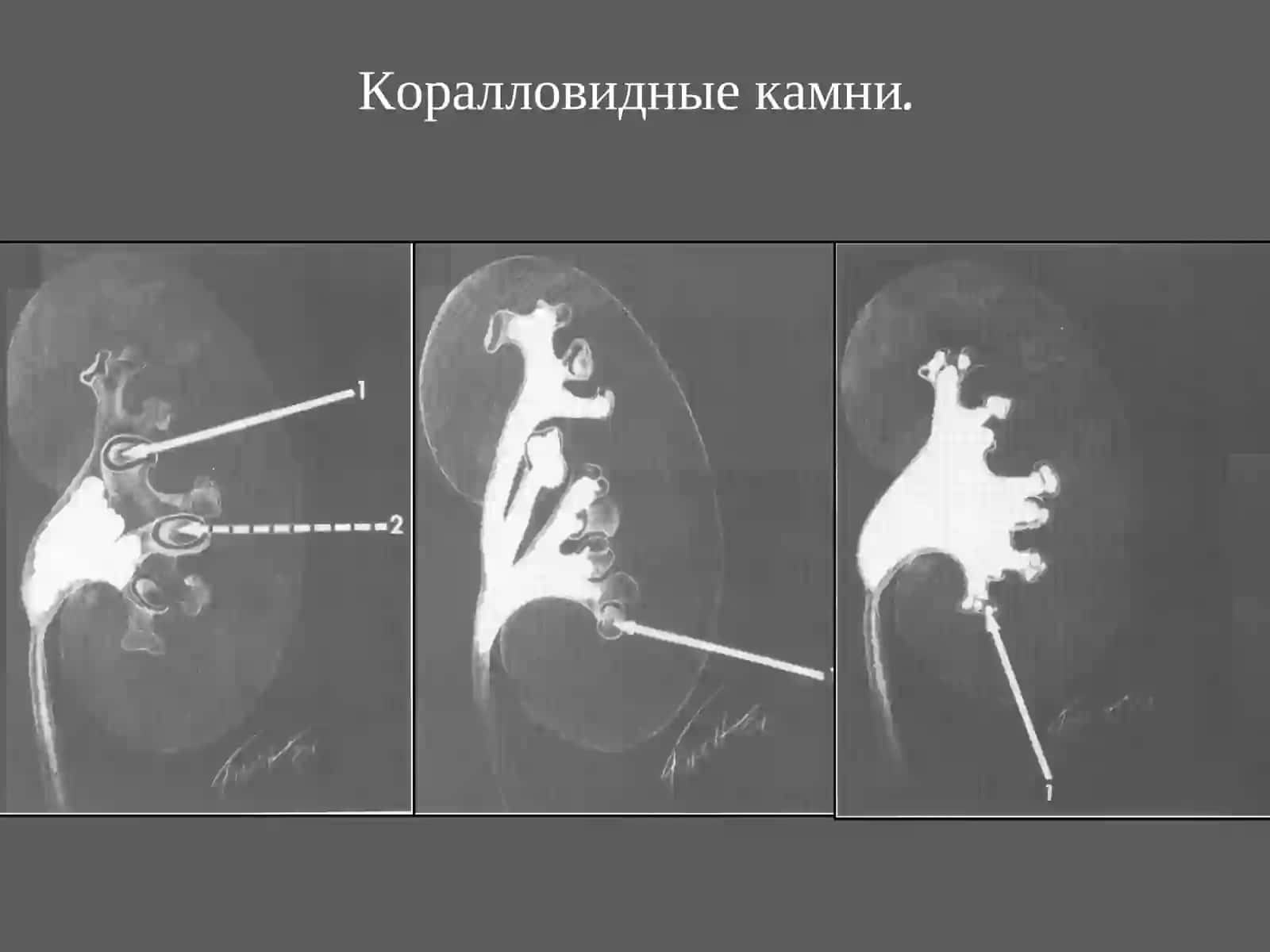 Мочекаменная болезнь (МКБ) 4