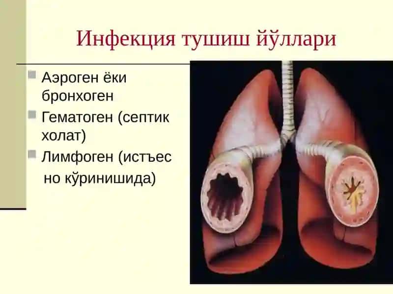Пневмония 4