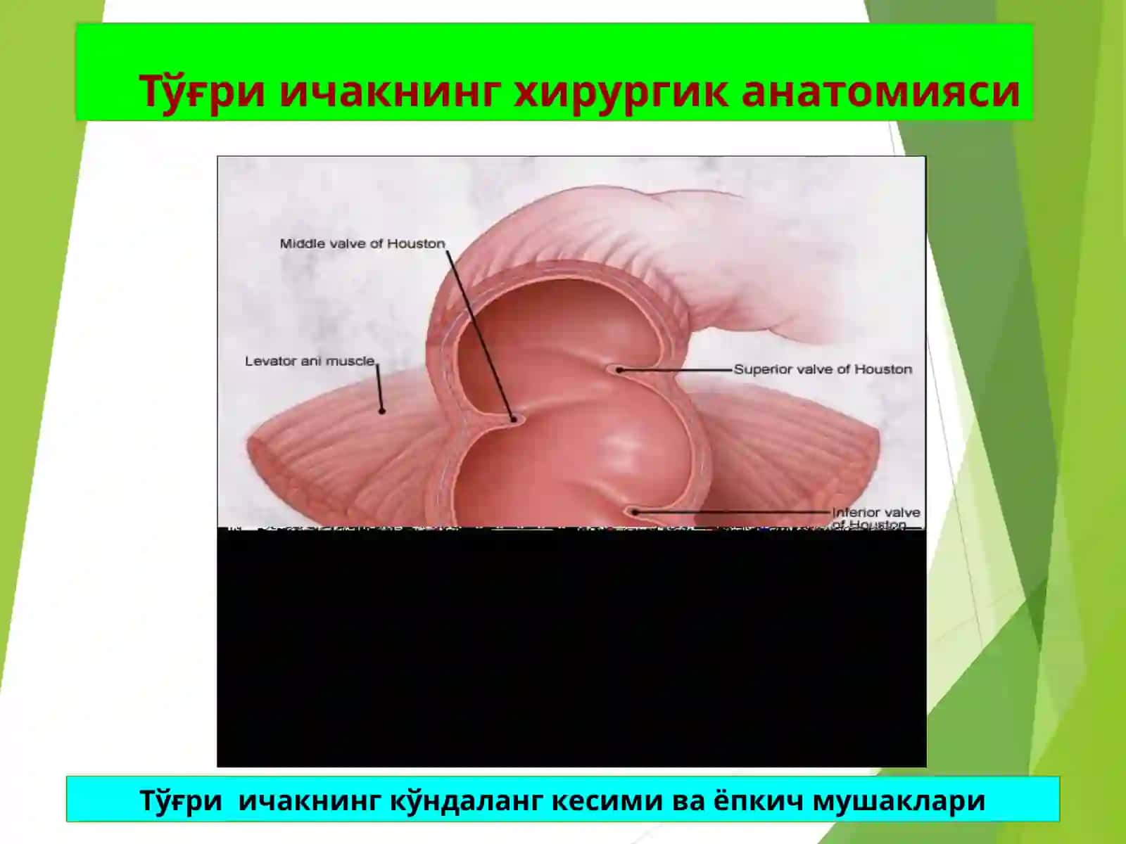 ТЎҒРИ ИЧАК КАСАЛЛИКЛАРИ 4