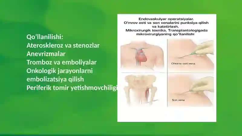 Endovaskulyar operatsiyalar. Oʻmrov osti va son venalarini punksiya qilish va katetirlash.  Mikroxirurgik texnika. Transplantologiya mikroxirurgiyaning qoʻllanilishi 4