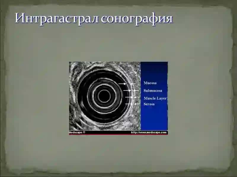 QORIN BOSHLIGI AZOLARI KASALLIKLARI TASHXISIDAGI ULTATOVUSHNING AXAMIYATI 4