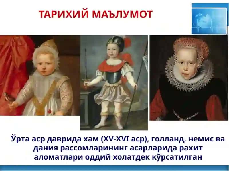 БОЛАЛАРДА СУЯК-МУШАК ТИЗИМИ АСОСИЙ КАСАЛЛИКЛАРИ СЕМИОТИКАСИ 4
