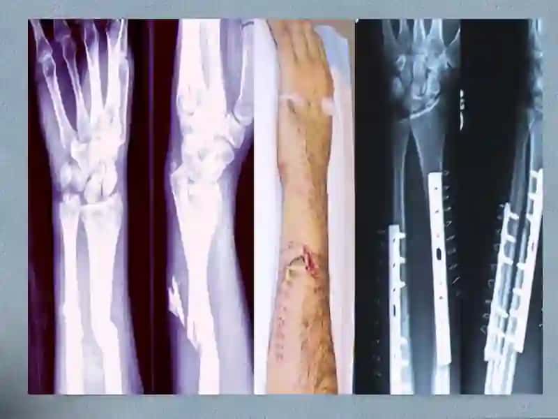 Bone fracture 4