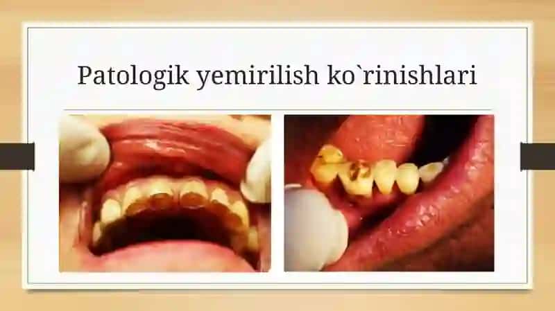 Tish qattiq to'qimasining fiziologik va patologik yemirilishi 4