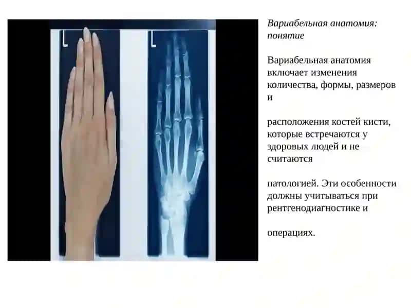 Вариабельная анатомия костей кисти и пороки развития 4