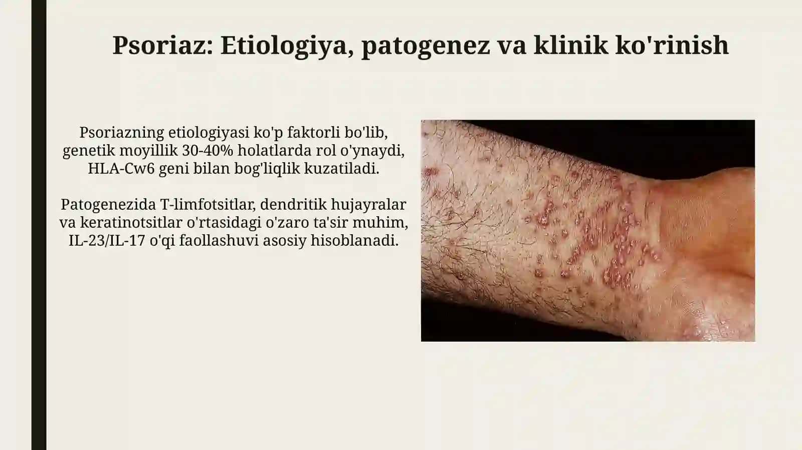 Papulyoz dermatozlar, Psoriaz, Qizil yassi temiratki 4