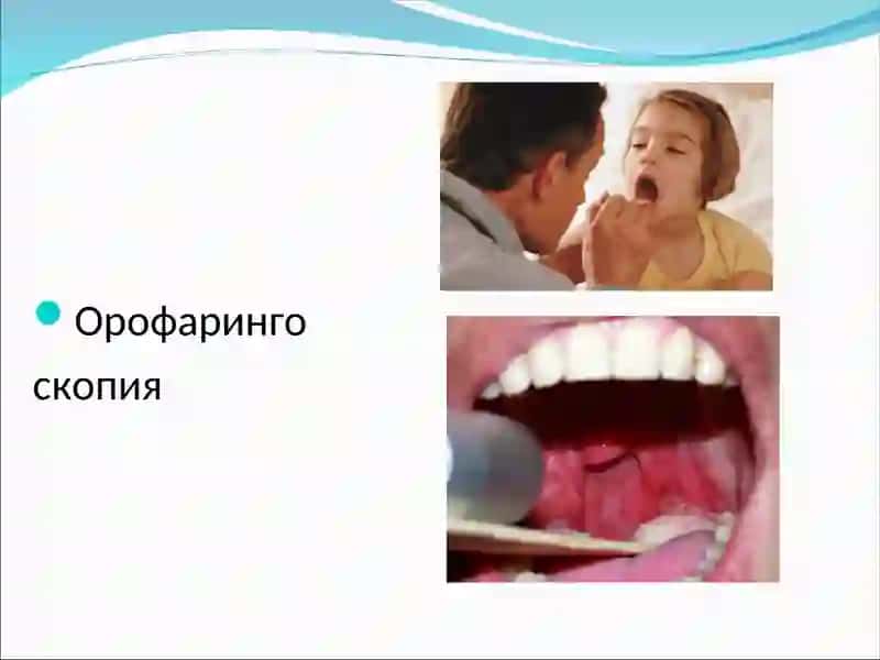 Ўткир тонзиллит (ангина) 4