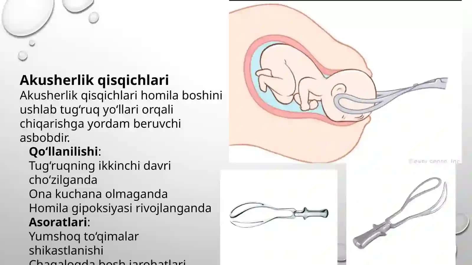 Tugʻruqni amalga oshiruvchi operatsiyalar | Kesar kesish, akusherlik qisqichlari, vakuum-ekstraksiya 4