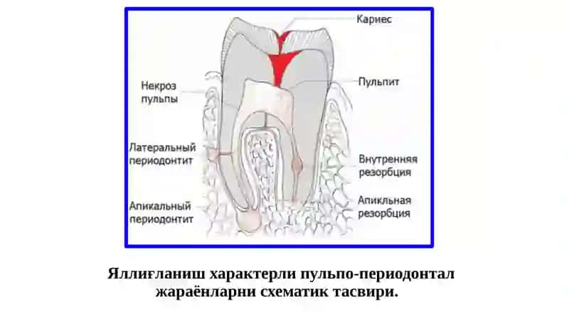 Ўткирва сурункали периодонтитларниклиникаси 4