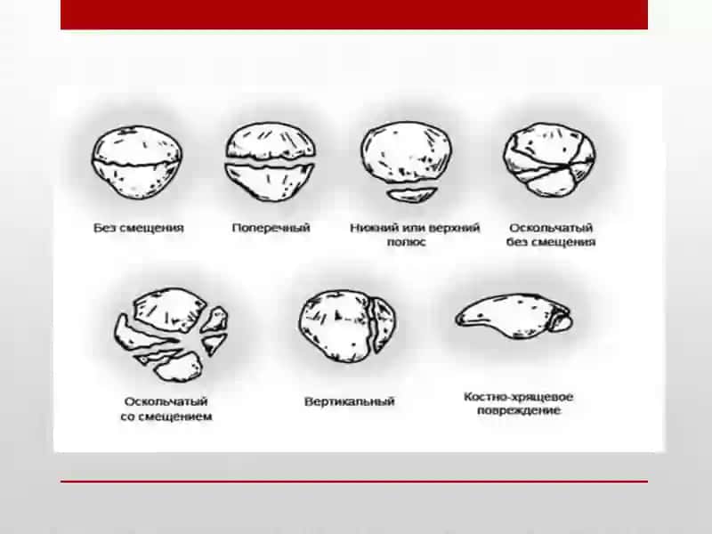 Patellar sinishi 4