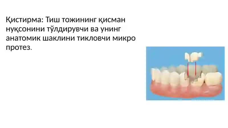 Тиш тожининг қисман нуқсони.клиникаси,этиологияси ва уни ортопедик стоматологик даволаш 4