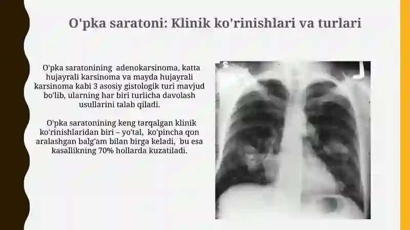 Pnevmoniya,o‘pka abssessi, o‘pka raki, o‘pka exonokokki klinik ko‘rinishi va shakllari 4