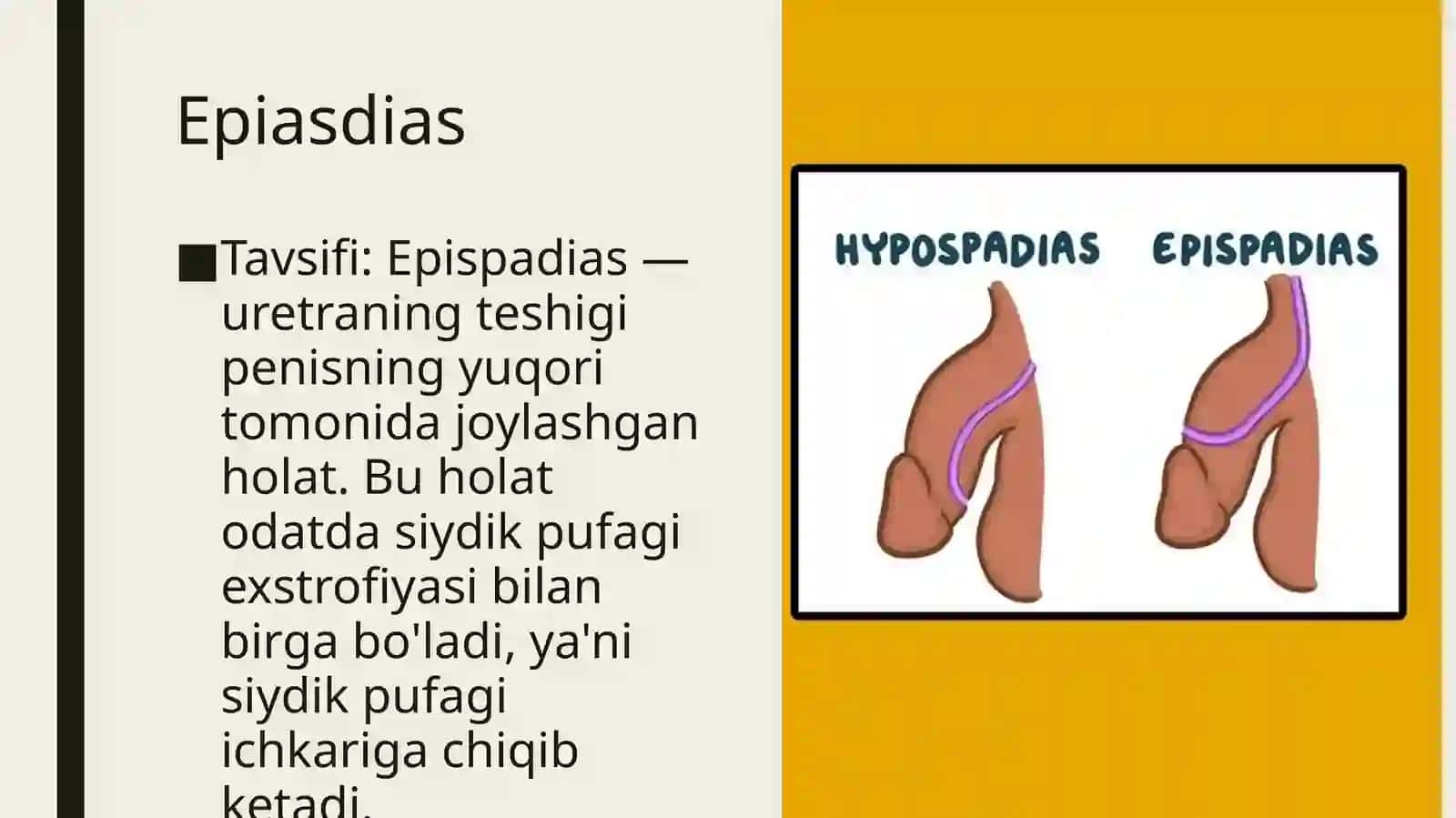 Uretra va moyaklar tug'ma nuqsonlari 4