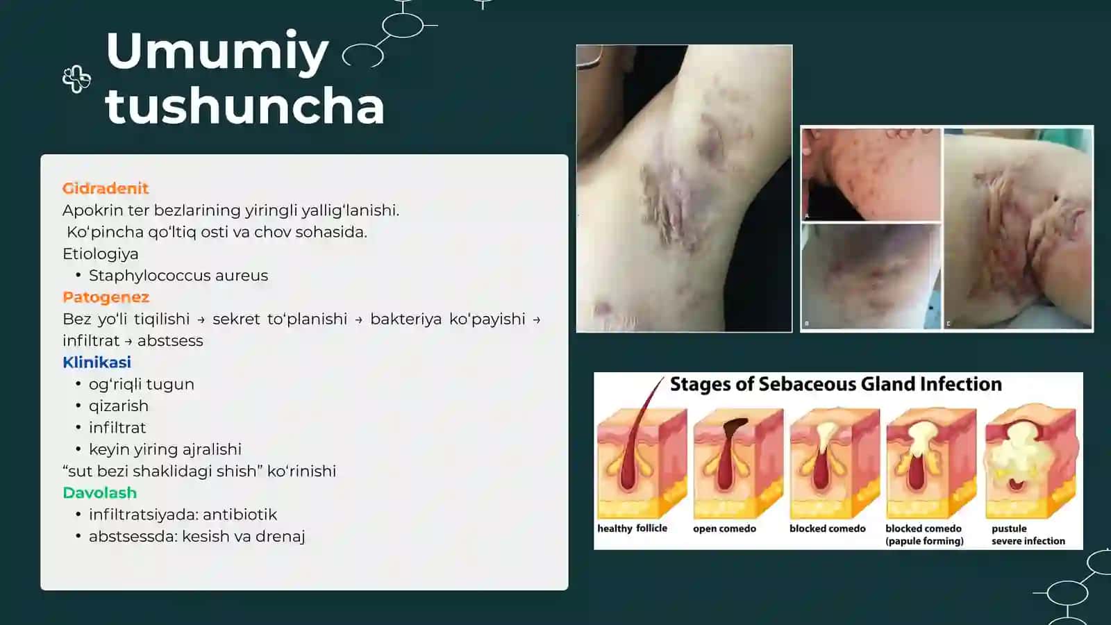 Yumshoq to‘qimalarning xirurgik infeksiyalari 4