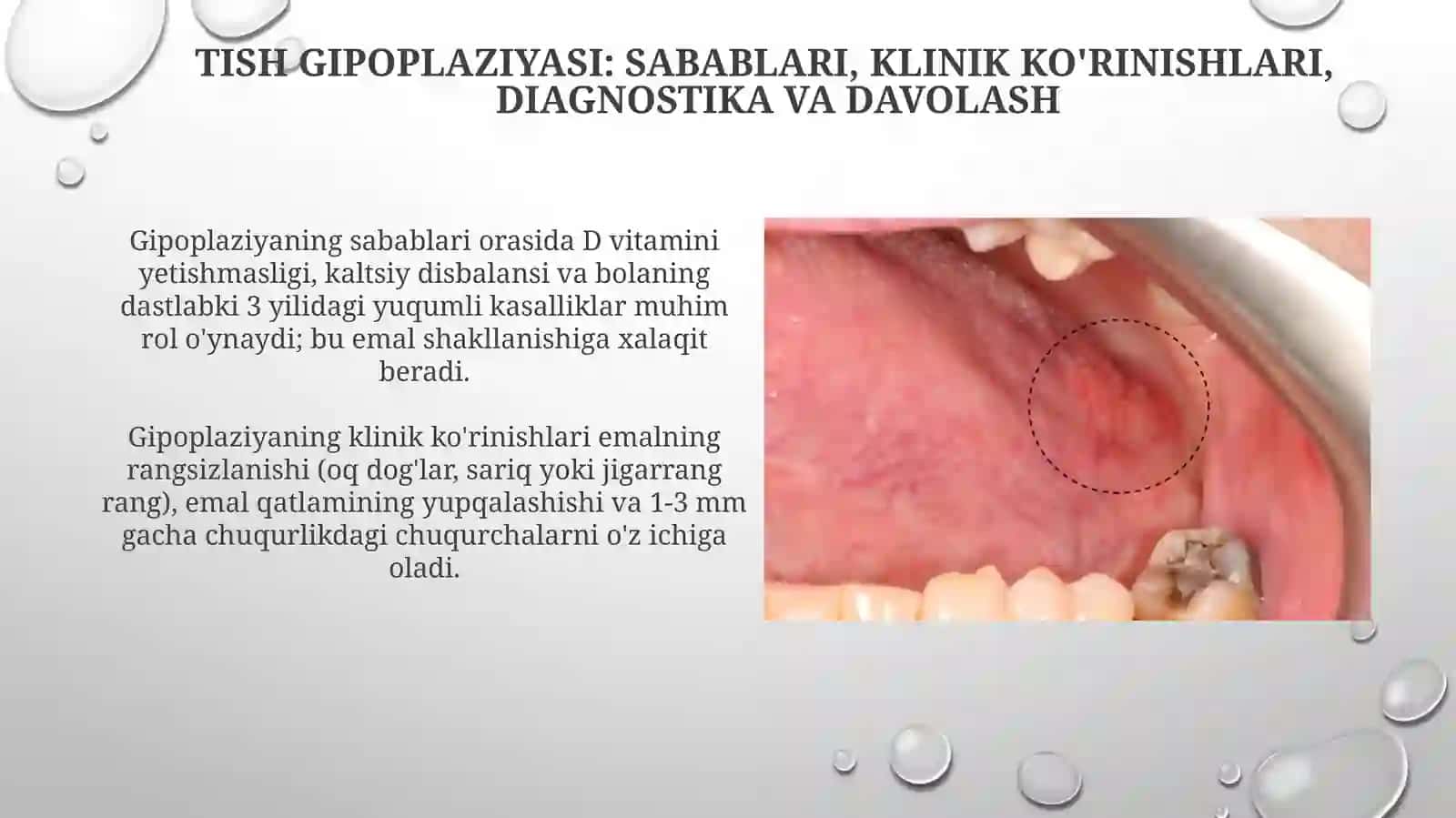 Tish to'qimalarining shikastlanishi: Gipoplaziya va Giperplaziya 4