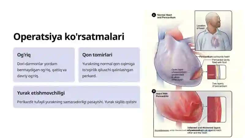 Perikarditlarda Operatsiyalar: Umumiy Ma'lumot 4