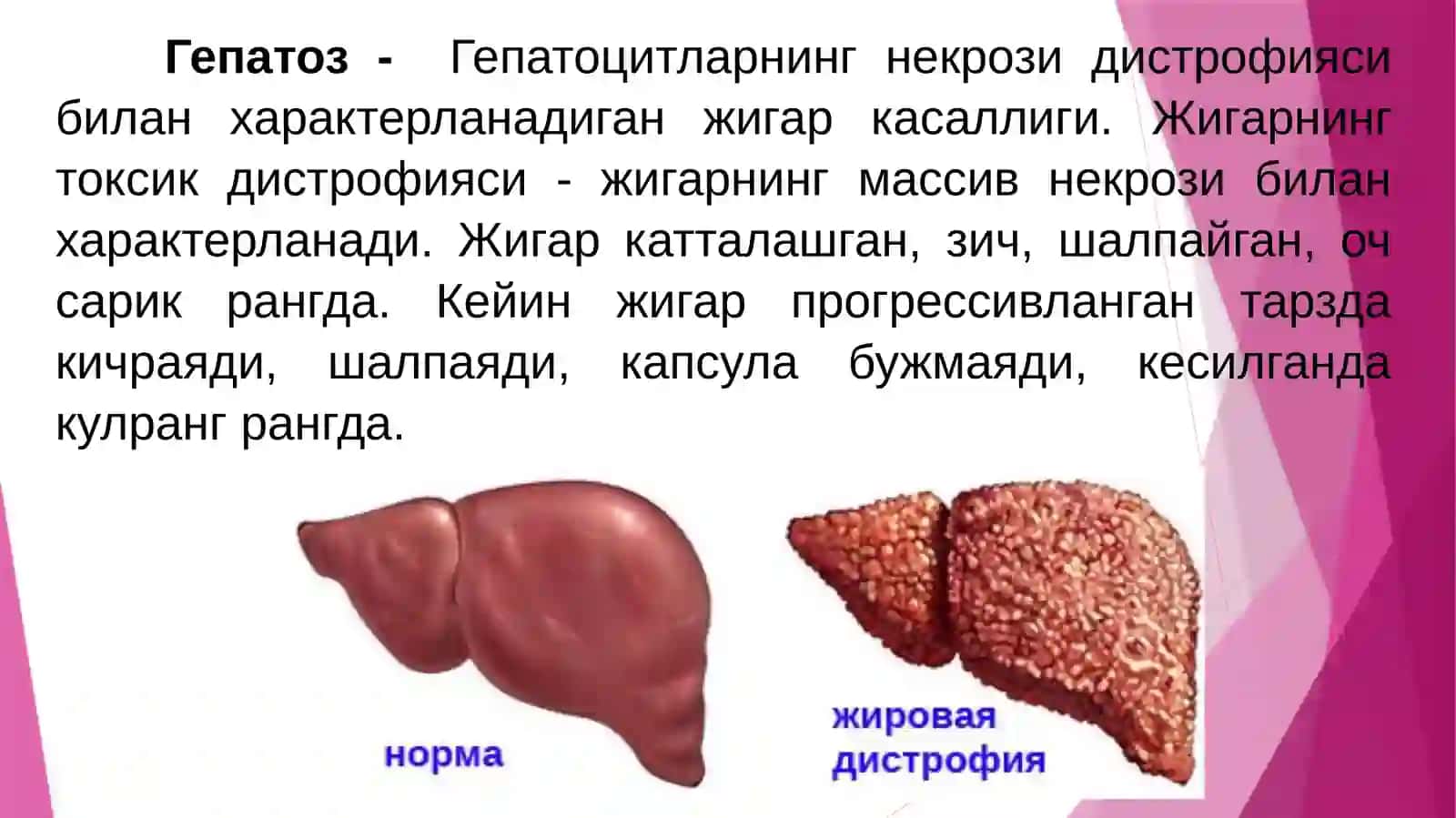 ГЕПАТОЗ. ГЕПАТИТ. ВИРУСЛИ ГЕПАТИТЛАР. СУРУНКАЛИ ГЕПАТИТ. ЖИГАР ЦИРРОЗИ. ПАТОМОРФОЛОГИЯСИ 4