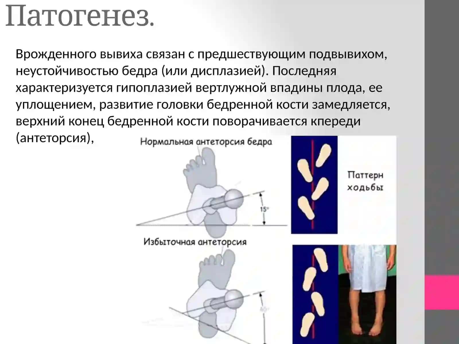 Врожденный вывих бедра(дисплазия тазобедренного сустава) 4