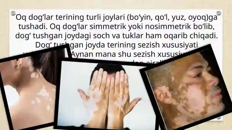Vitiligoning zamonaviy davolash usullari 4