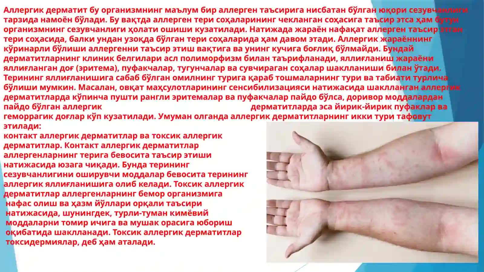 Oddiy va allergik dermatit. Toksik-allergik dermatit. Ekzema 4