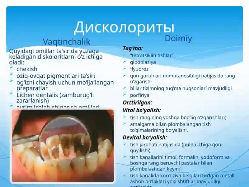 Nokarioz kasalliklarda tishlarni oqartirish prinsiplari 4