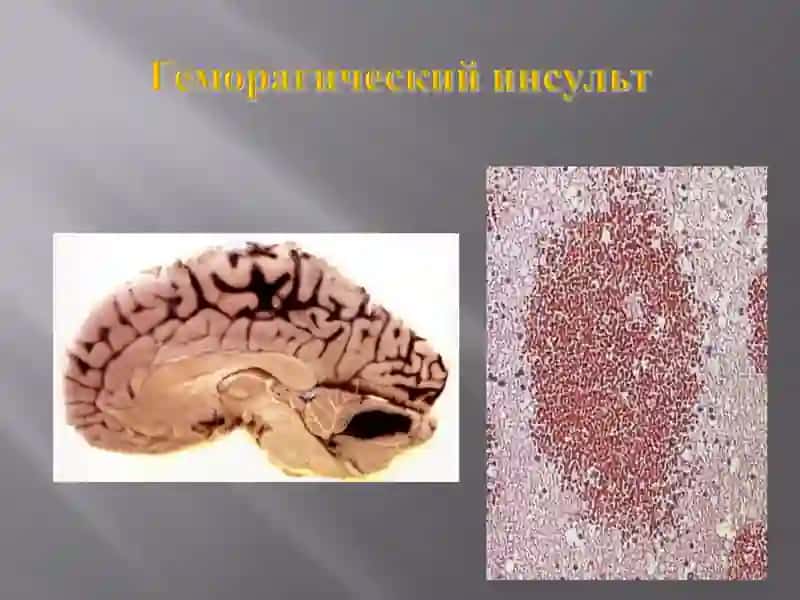 Нарушение обмена гемоглобиногенных пигментов 4