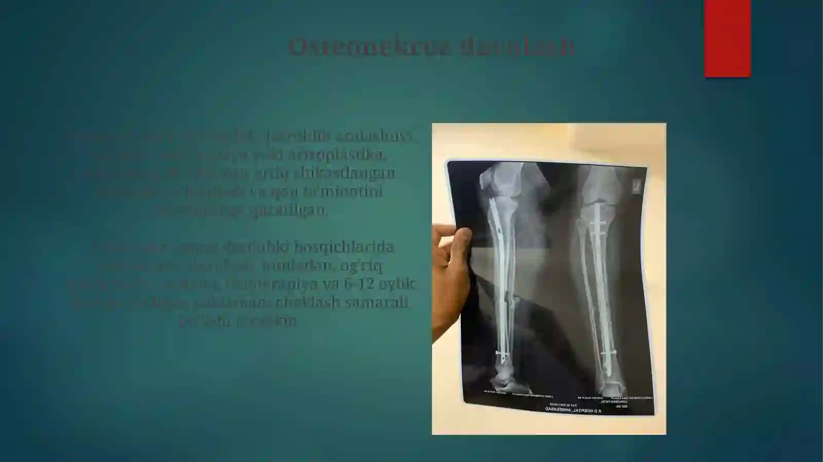 Suyaklarning rivojlanish buzilishi patanatomiyasi. Sinish. Osteonekroz 4