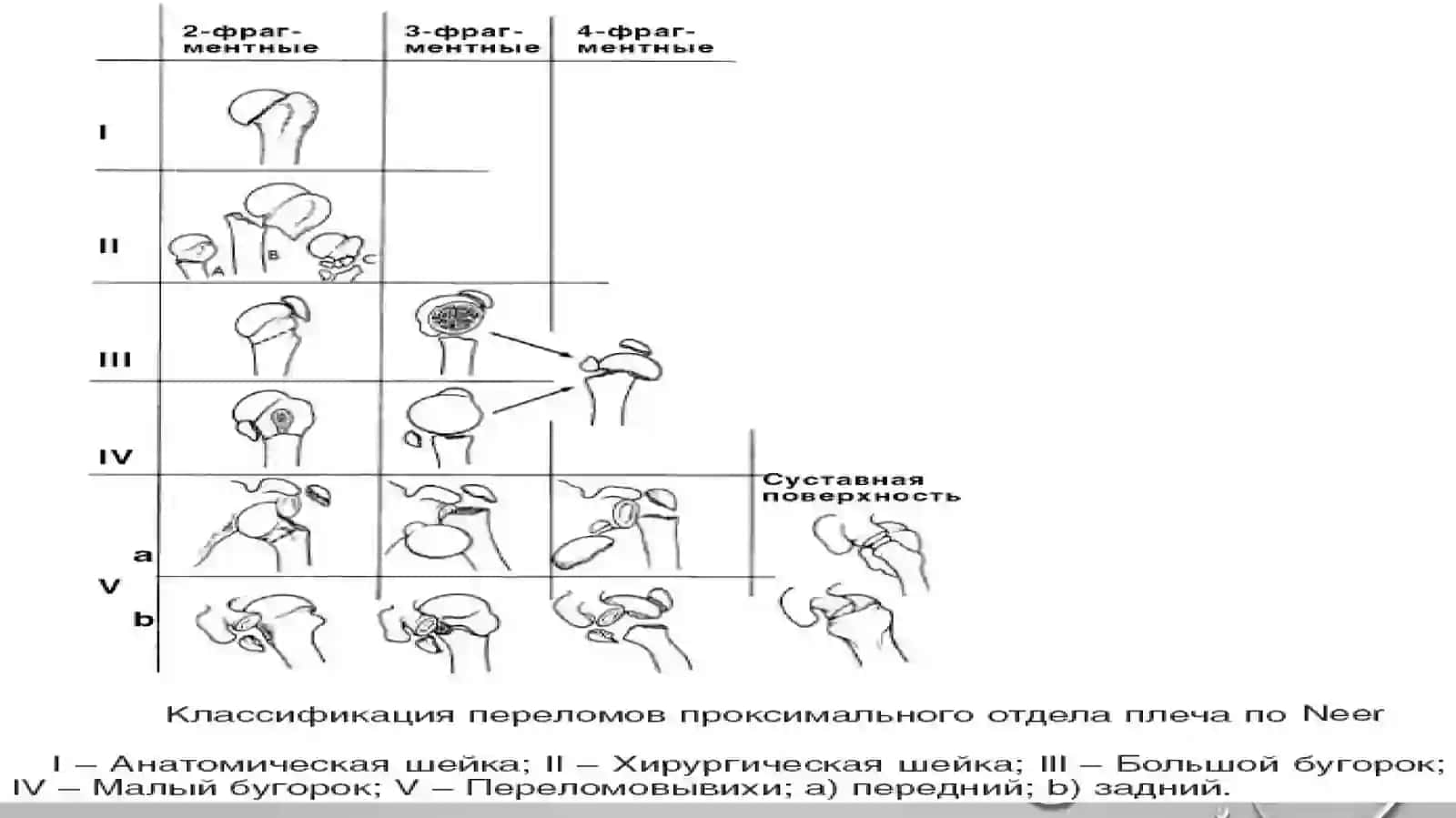Yelka suyaklarining sinishlari va yelka suyakgi boshchasini chiqishi 4