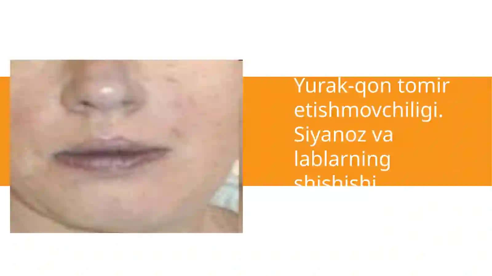 Yurak-qon tomir tizimi kasalliklarida og'iz bo'shlig'i shilliq qavatidagi o'zgarishlar 4