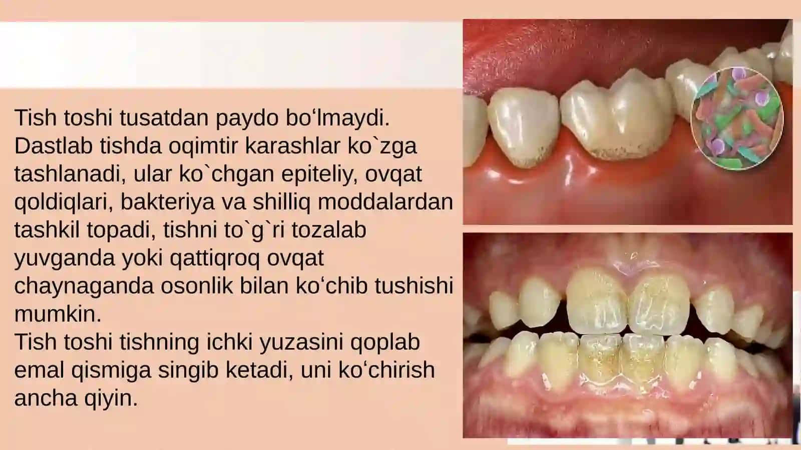 Tish usti yumshoq karashlari va ularning parodont kasalligi yuzaga kelishidagi o`rni. 4