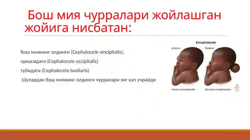 BOSH MIYA VA ORQA MIYANING TUG’MA RIVOJLANISH NUQSONLARI 4