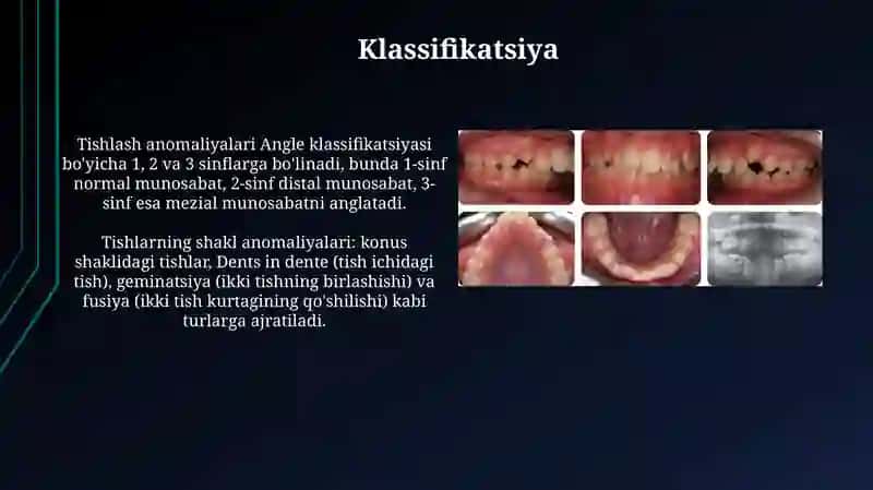 Tishlash va tishlarning rivojlanishidagi anomaliyalar 4