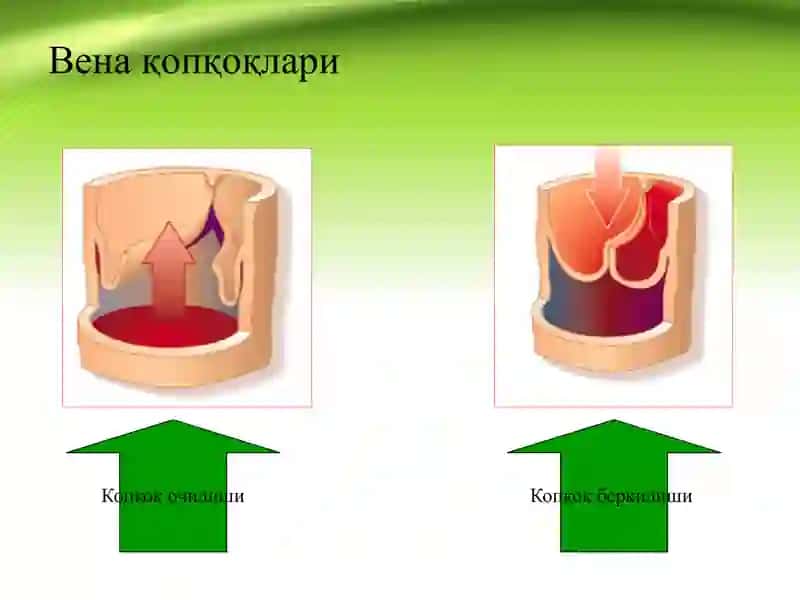 Оёқ веналарининг варикоз касаллиги Varikoz kasalligi 4