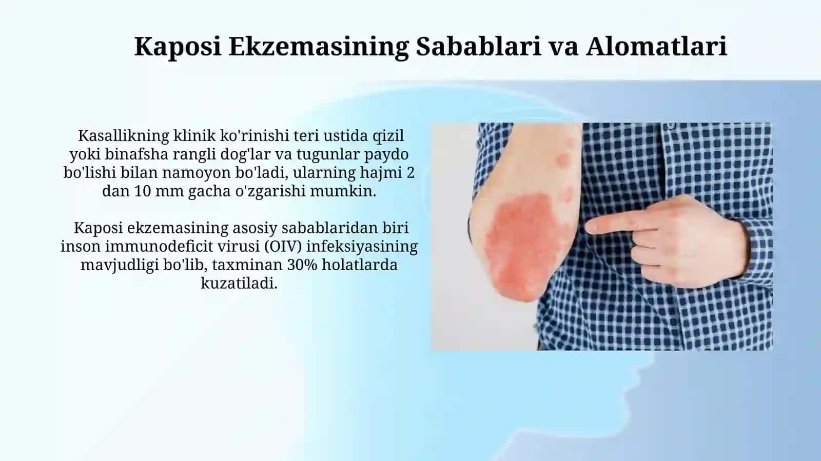 Kaposhi sarkomasi. Kaposhi ekzemasi 4